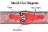 Illustration d'un caillot de sang